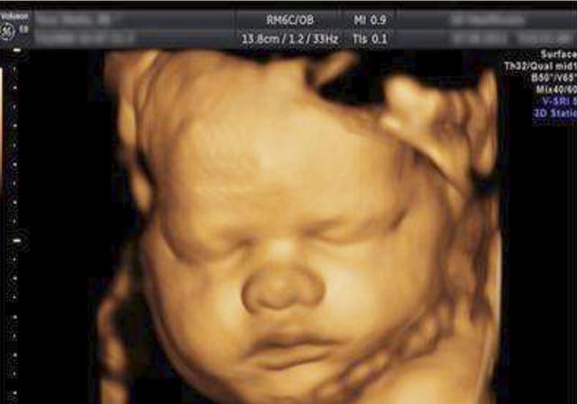 四维彩超怎么看胎儿是男是女呢（四维照片一看就是男孩）