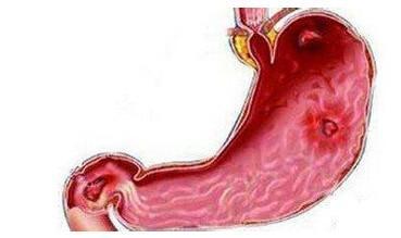 淤血型胃出血用中药,胃出血有何中药或土治疗法可缓解